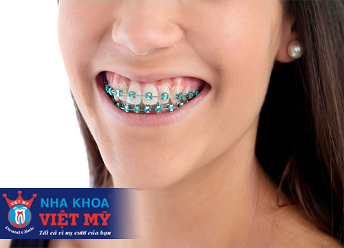 niềng răng có đau không và giá bao nhiêu là rẻ nhất