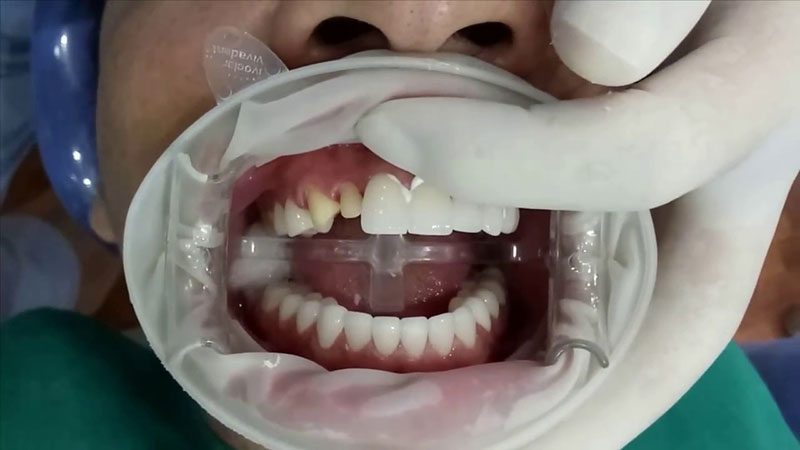 Răng sứ vita có tốt không?