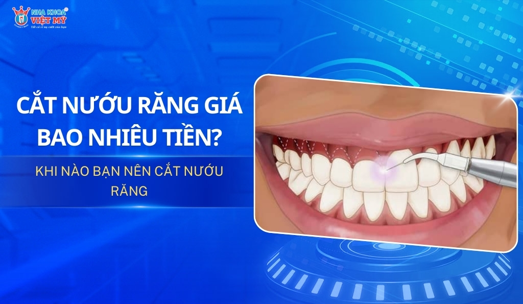 Cắt nướu răng thẩm mỹ giá bao nhiêu tiền? [Tháng 1/2025]
