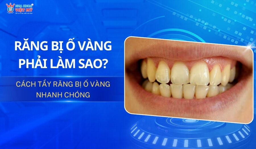 thumbnail răng bị ố vàng phải làm sao