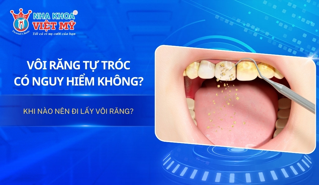 Vôi răng tự tróc có nguy hiểm không? Khi nào nên đi lấy vôi răng?