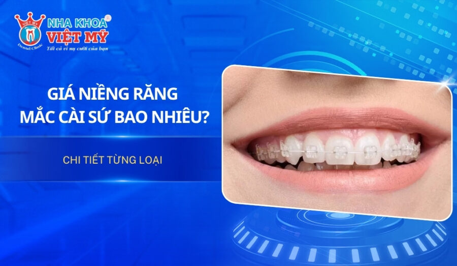Giá niềng răng mắc cài sứ bao nhiêu? Chi tiết từng loại