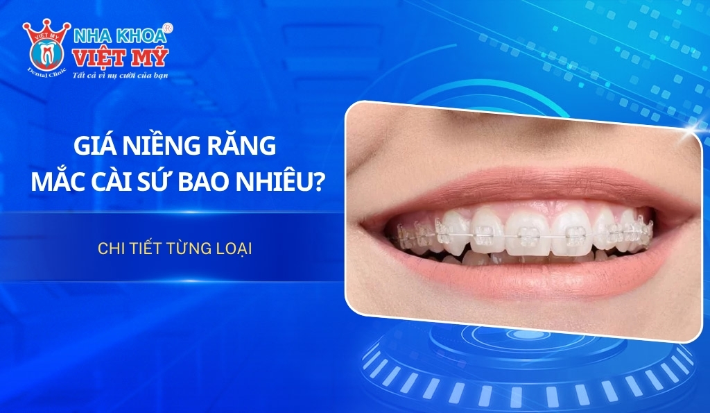 Giá niềng răng mắc cài sứ bao nhiêu? Chi tiết từng loại