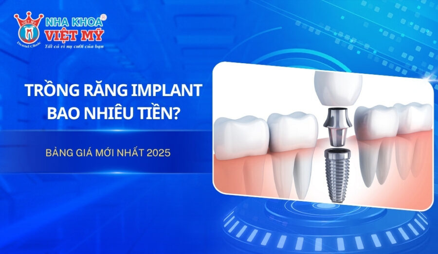 Trồng răng implant bao nhiêu tiền? Bảng giá mới nhất 2025