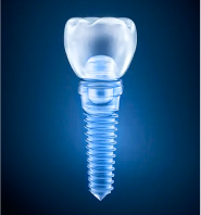 Trồng răng Implant