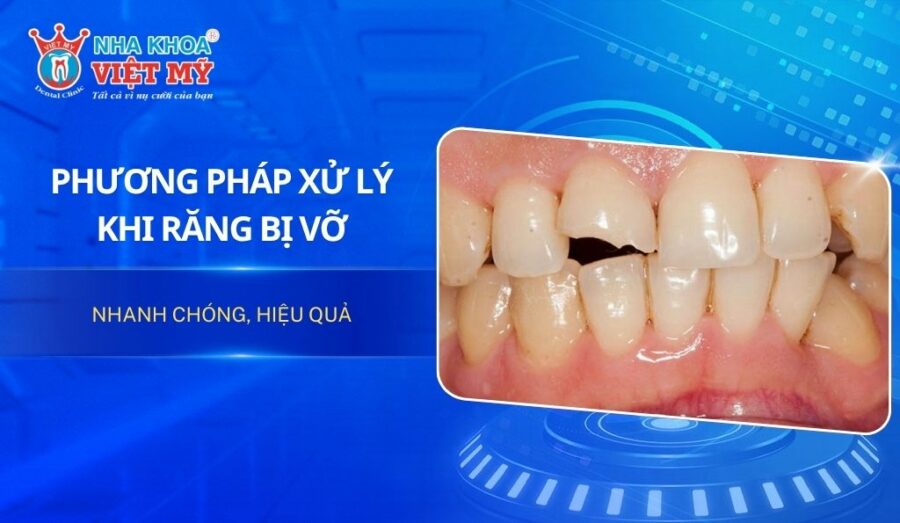 Phương pháp xử lý khi răng bị vỡ nhanh chóng, hiệu quả
