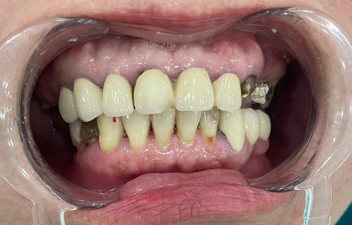 KH. Ngọc Dung làm răng tại nha khoa Việt Mỹ