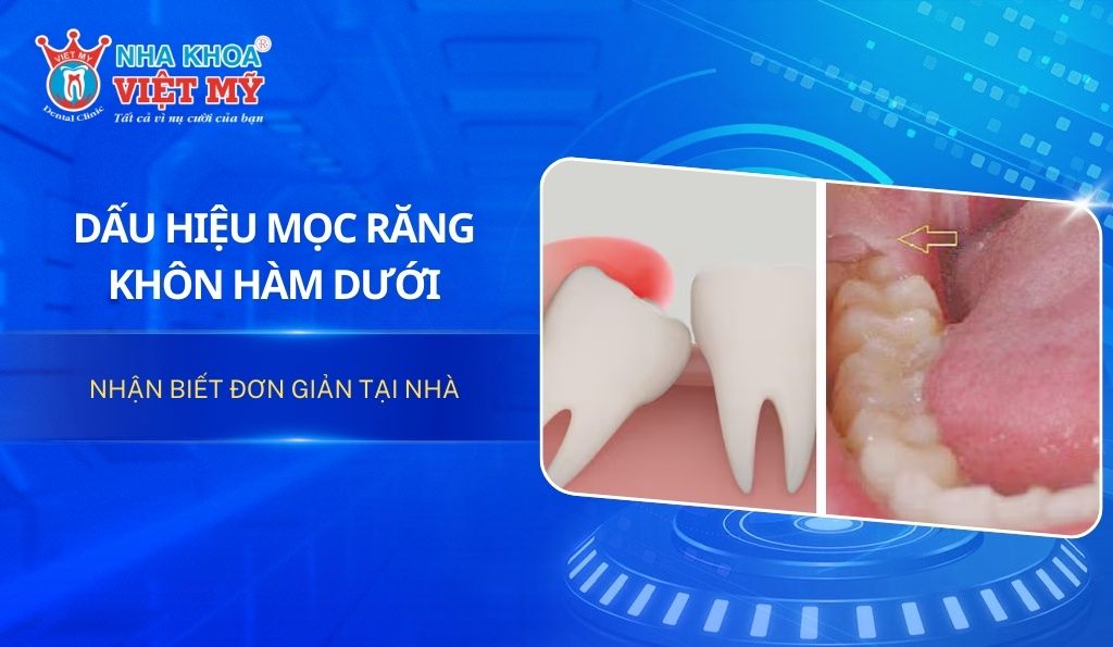 Dấu hiệu mọc răng khôn hàm dưới dễ nhận biết tại nhà