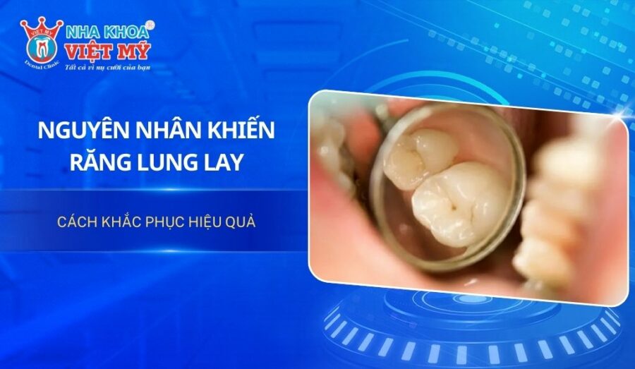 Nguyên nhân răng bị lung lay và cách điều trị hiệu quả