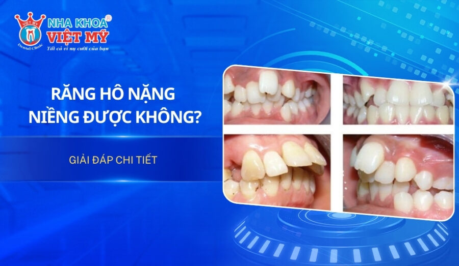 Răng hô nặng có niềng được không?
