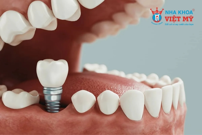 Trồng răng Implant là gì?